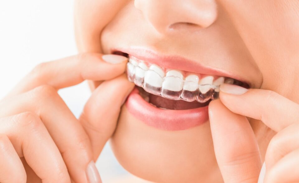 How much does it cost to get dental braces and Invisalign in
